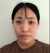 激光點痣10天后的圖片分享！附上我的親身經(jīng)歷介紹