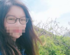 腫眼泡抽脂圖片曝光！給大家看看真人做腫眼泡抽脂后的果