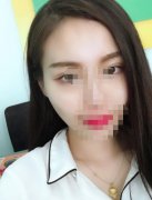 太陽凹陷填充前后對比圖來襲！做完之后臉部線條更精致啦！