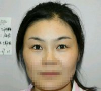 開外眼角圖片前后對比明X嗎？來看本人做眼角手術(shù)真實(shí)果就知道了