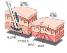 全身抽脂要多少錢？價格的高低和哪些因素有關呢？