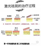 激光美容祛斑價格是多少？與你的選擇有很大關(guān)系！