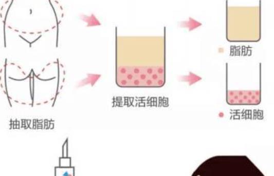 自體脂肪