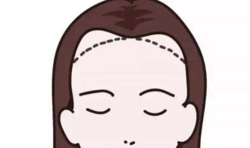 發(fā)際線