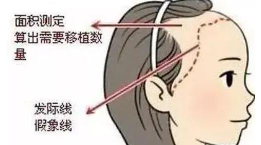 發(fā)際線