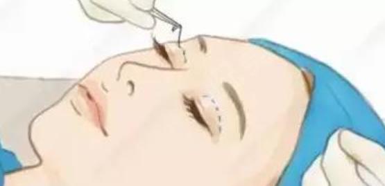 雙眼皮