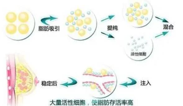 自體脂肪