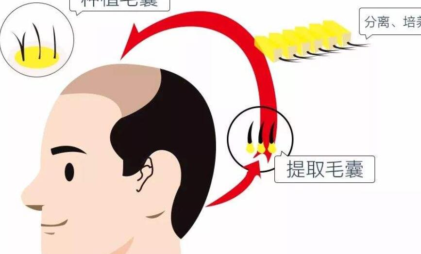 禿鬢角種植