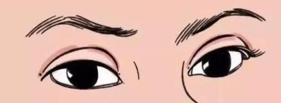 雙眼皮
