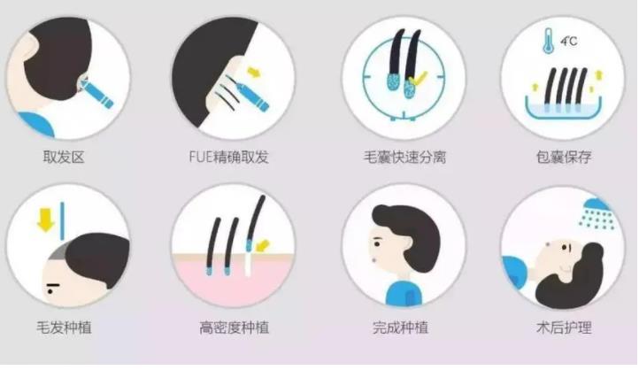 頭發(fā)種植