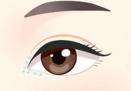 內(nèi)眼角