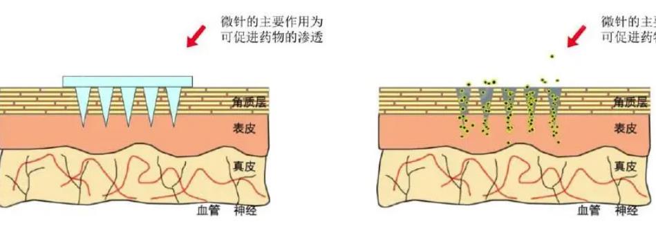 微針動漫02.jpg