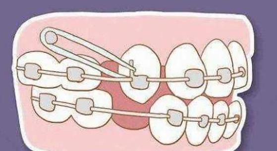 牙齒矯正動漫h4.jpg