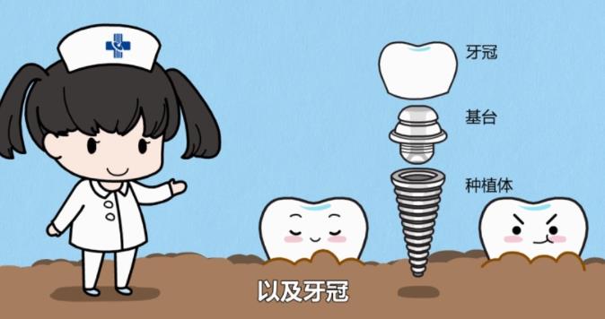 牙齒種植dm01.jpg
