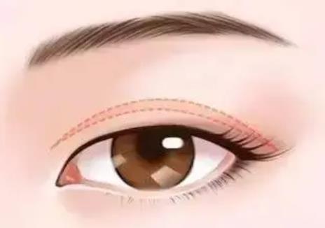 開內(nèi)眼角恢復(fù)過程分享！戳進來看看真人做開眼角手術(shù)前后的對比圖吧！