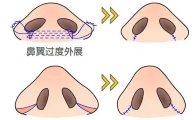 鼻頭肥大動(dòng)漫01.jpg