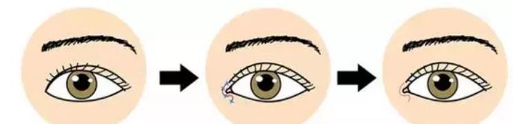 雙眼皮動漫hg7.jpg