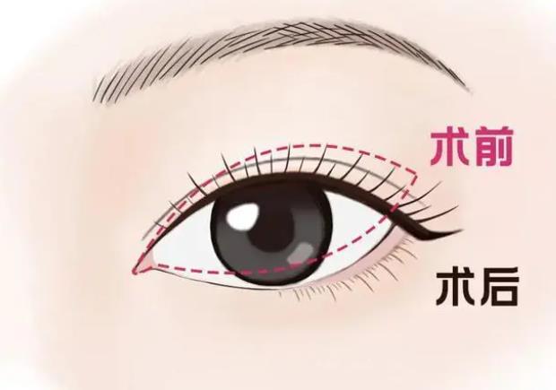 雙眼皮動(dòng)漫001.jpg