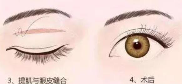 雙眼皮dm2.jpg