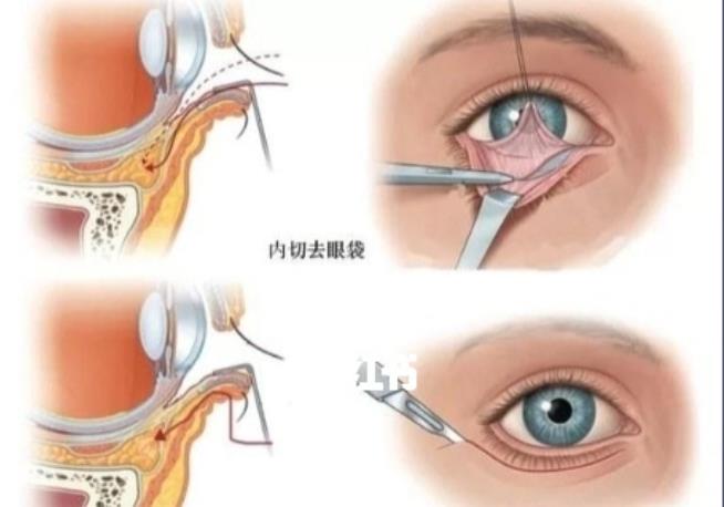 內(nèi)切祛眼袋的案例分享！真人做眼袋去除手術后60天真實果反饋！
