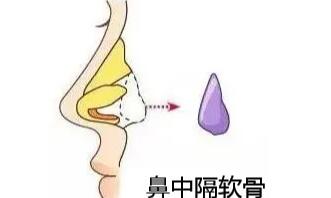耳軟骨隆鼻子大概多少費用03.jpg