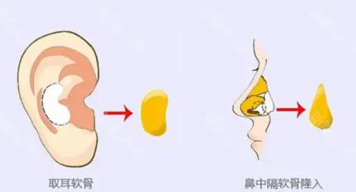 耳軟骨隆鼻子大概多少費用01.jpg