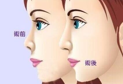 隆鼻動漫21.jpg
