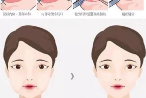 去頰脂墊對(duì)比圖大公開！果！分享真實(shí)案例！快來了解一下吧！