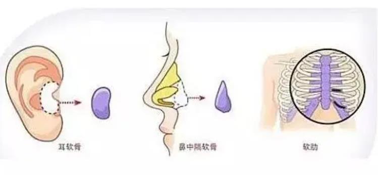 軟骨隆鼻1.jpg