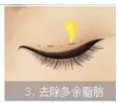 長沙湘雅醫(yī)院可以做雙眼皮嗎？院內(nèi)那位醫(yī)生的技術(shù)比較好？附案例
