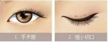 雙眼皮1.jpg