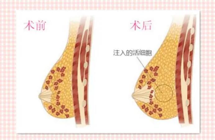 自體脂肪隆胸2.jpg