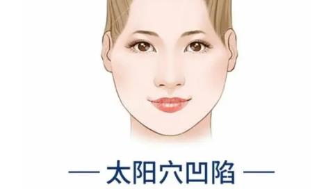 太陽穴凹陷h11.jpg