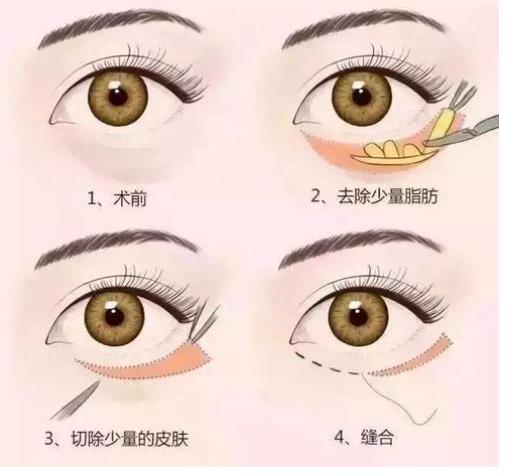 眼袋手術(shù).jpg