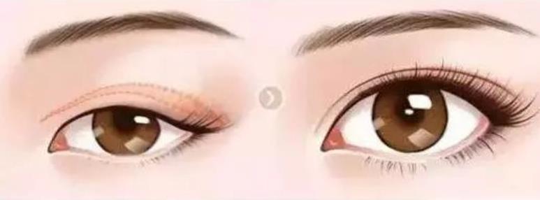 雙眼皮003.jpg