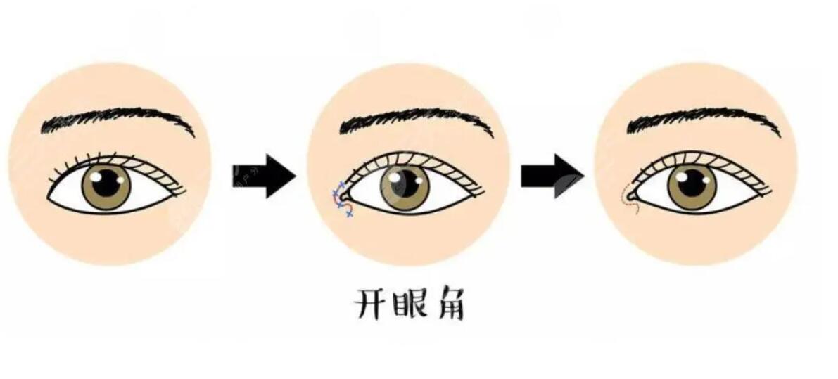 開眼角外眼角容易回縮？費(fèi)用貴不貴？注意事項(xiàng)有哪些？
