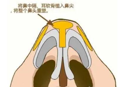 鼻頭縮小動漫01.jpg
