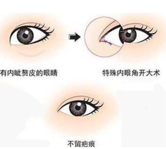 開眼角3.jpg