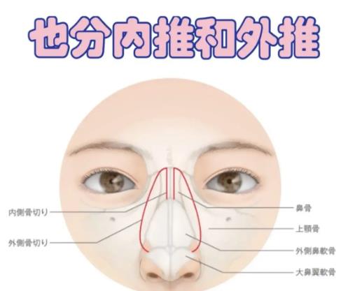 鼻骨內推05.jpg