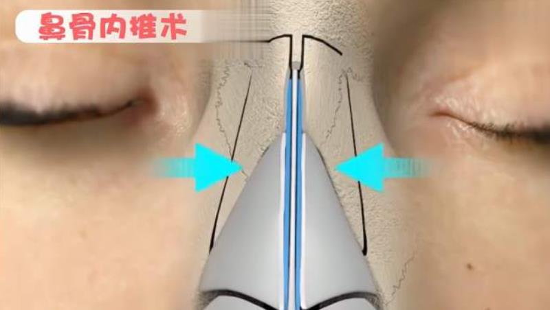 鼻骨內(nèi)推前后對比照曝光|真人做鼻骨內(nèi)推手術(shù)之后恢復(fù)期記錄分享！