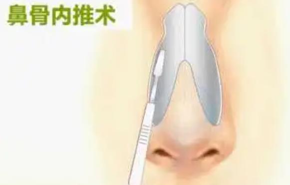 鼻骨內推03.jpg
