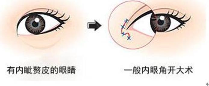 雙眼皮h14.jpg