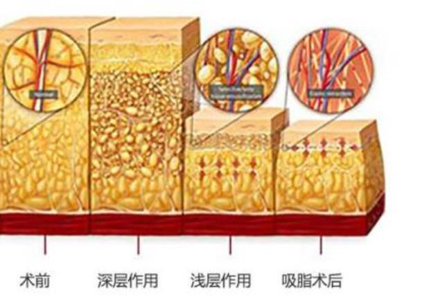 激光溶脂.jpg