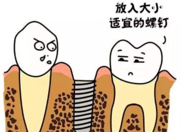 牙齒種植dm05.jpg