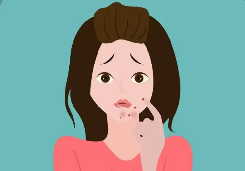 怎么去除痘印痘疤呢？你想知道的都在這里哦！