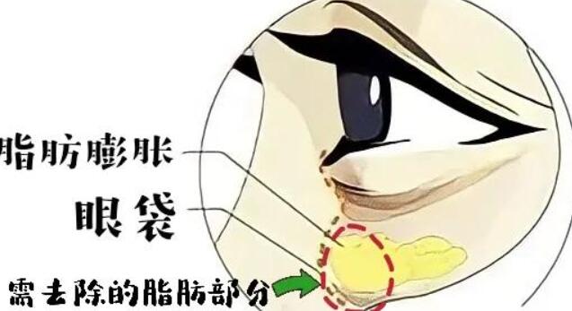 去眼袋動(dòng)漫51.jpg