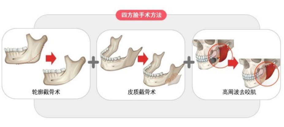 下頜角01.jpg