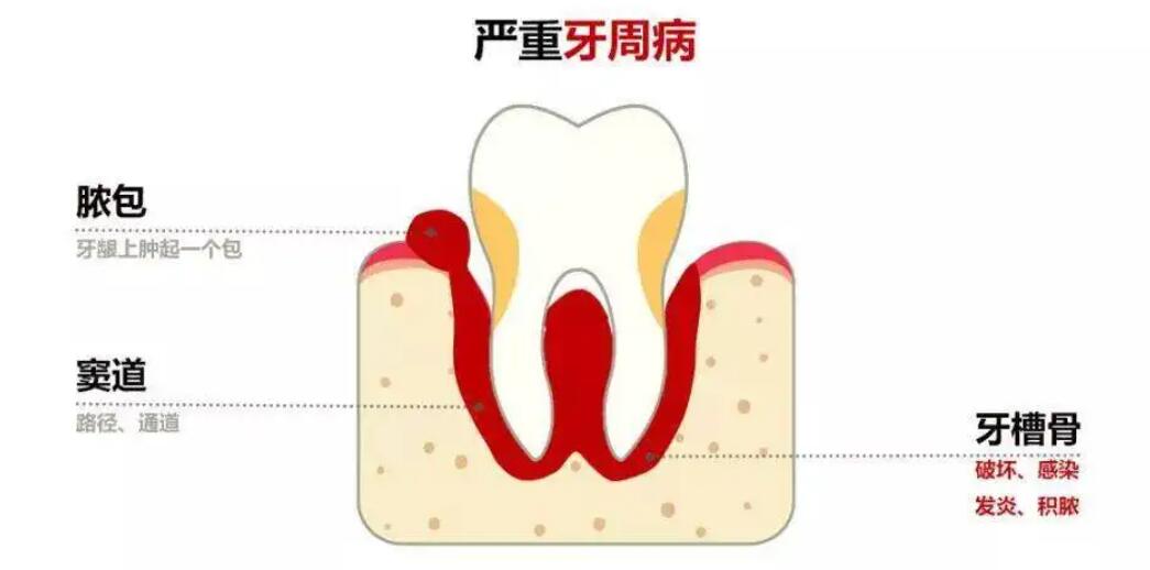 牙齦膿包動漫.jpg