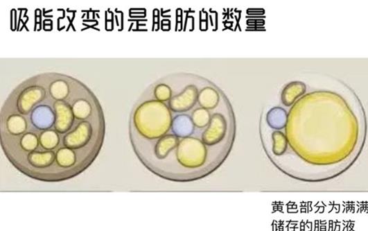 吸脂h41.jpg