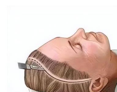 北京加減美做的拉皮除皺術(shù)帶來驚人效果，90天告別皺紋！